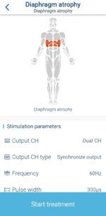 Diyafram Atrofisi Elektriksel Sinir Stimülasyon (NMES) Cihazı - Görsel 2